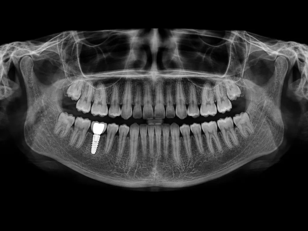 Panoramic dental X-ray showing a full set of teeth and one implant in the lower jaw