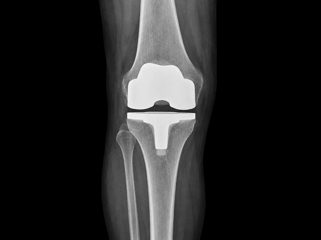 Front-view X-ray of a knee with a total knee replacement implant